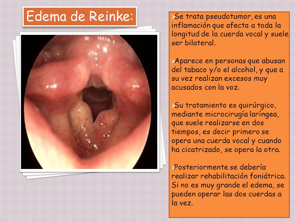 Edema cuerdas vocales operacion